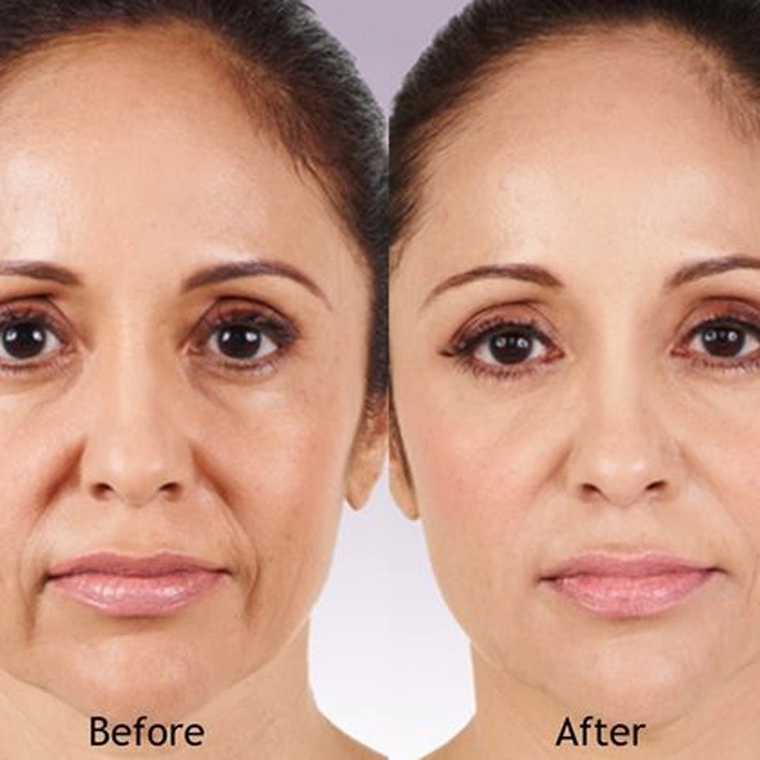 Hyaluronic Acid Plus 1% display — professional anti-aging skin rejuvenation mesotherapy | SlimSpa