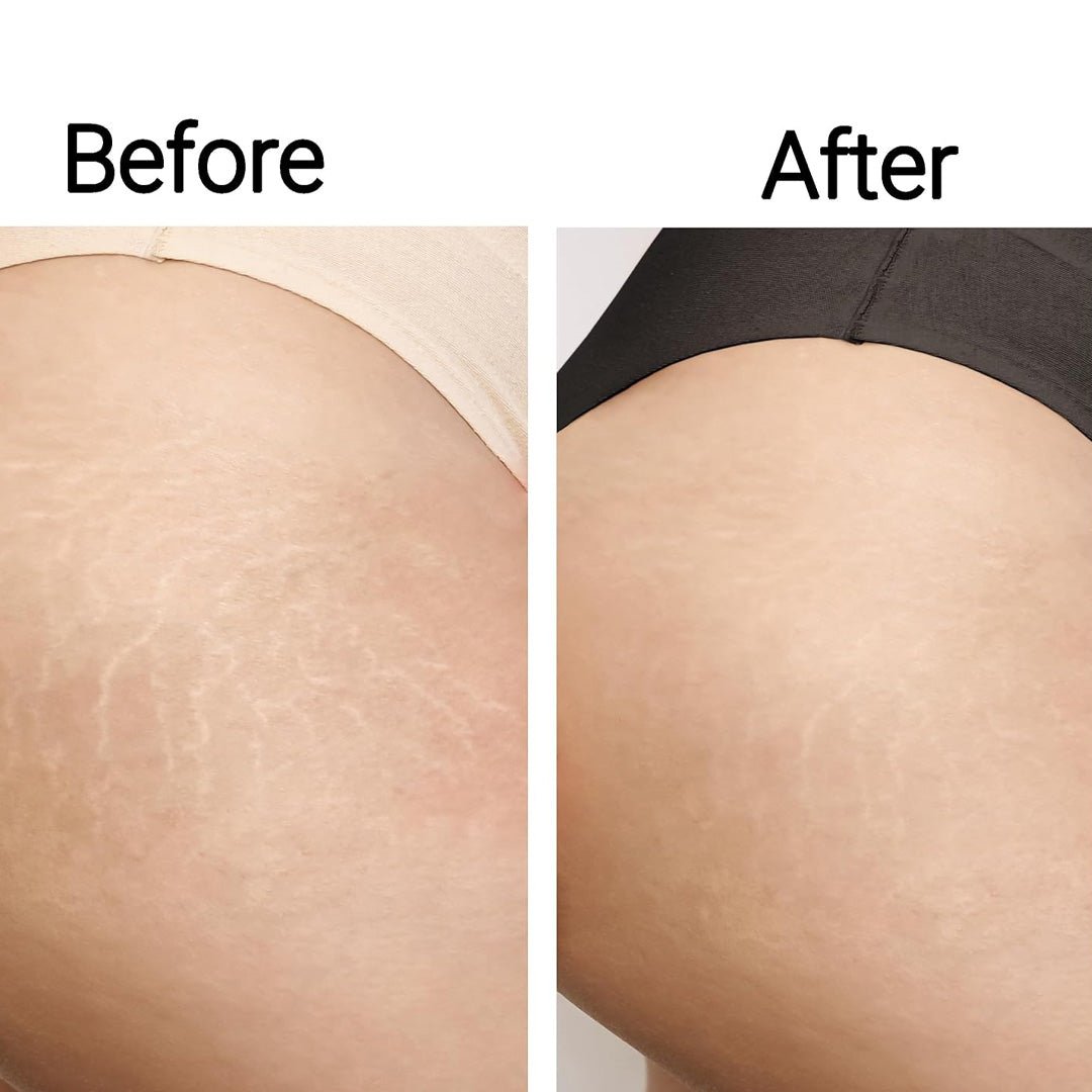 StriaeSolution Serum texture — fast-absorbing stretch mark treatment for licensed esthetician clients, wholesale